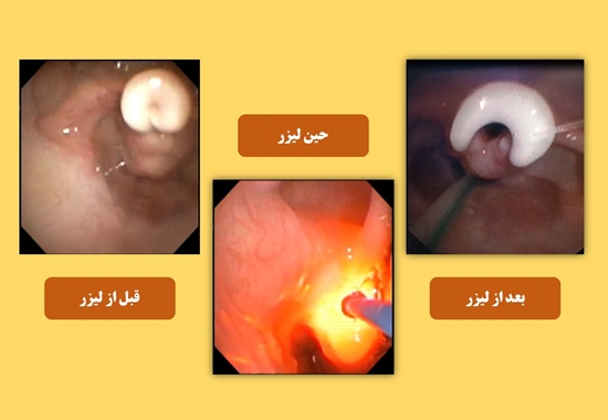 استفاده از لیزر برای درمان نرمی حنجره در بخش ریه مرکز طبی کودکان با موفقیت انجام شد 